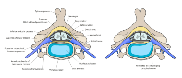 Anatomy of Neck (Cervical Spine) Pain - Spinomax