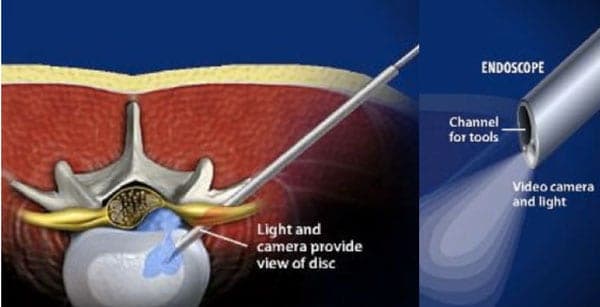 Retroperitoneal totally endoscopic prosthetic repair of lumbar hernia