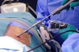 open spine surgery