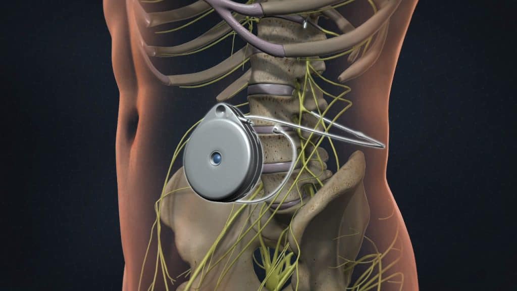 Intrathecal Infusion Pump - Dr. Manish Raj