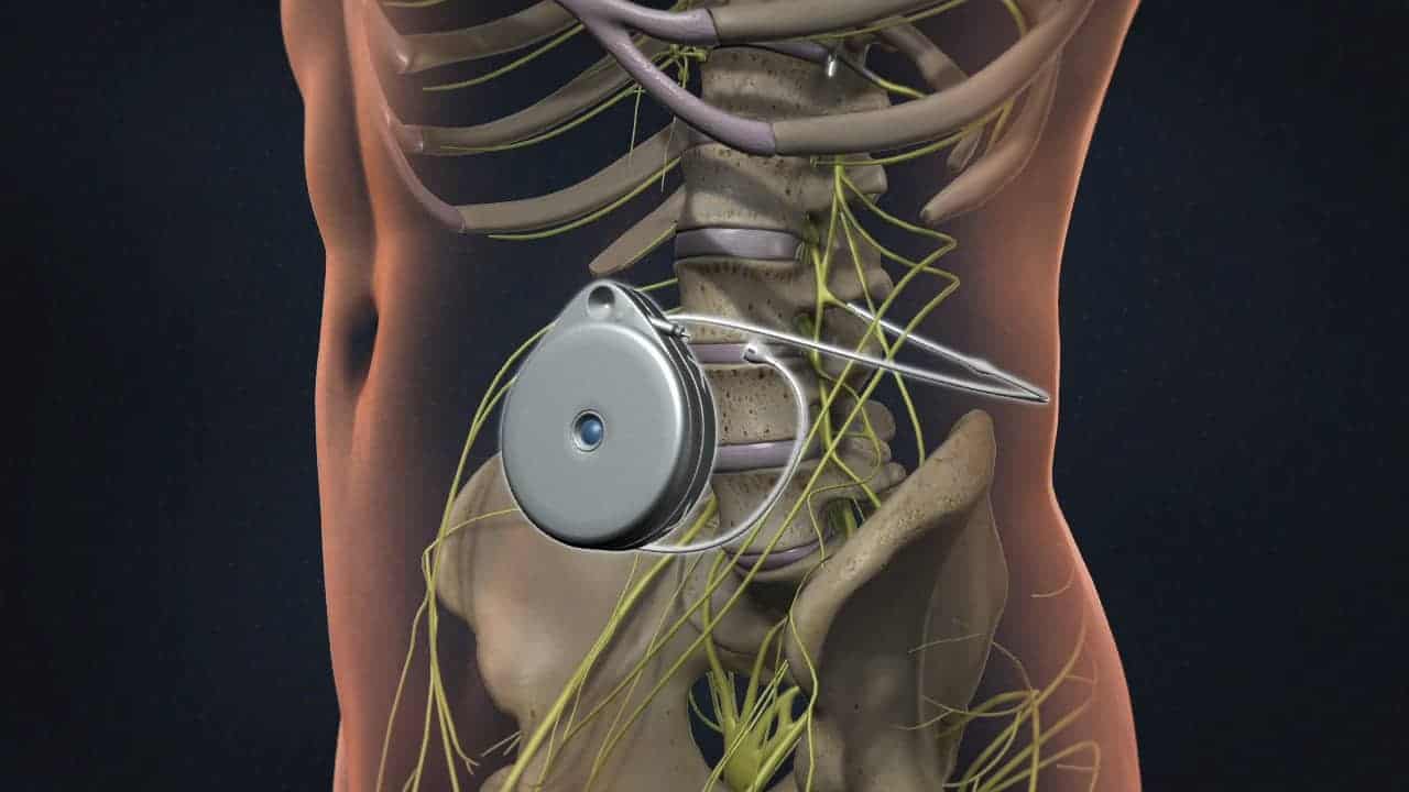 Intrathecal Infusion Pump - Spinomax