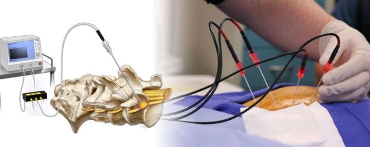 https://spinomax.com/wp-content/uploads/2018/03/RADIOFREQUENCY-ABLATION-1.jpg