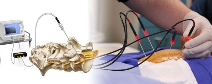  Radiofrequency Ablation Spinomax