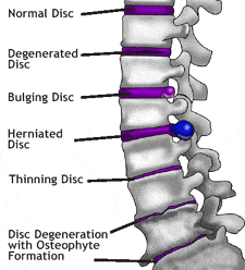 Anatomy Of Lower Back (Lumbar Spine) Pain - Spinomax