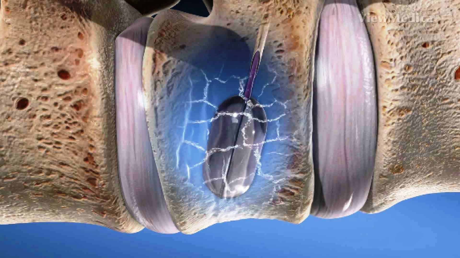 Treatment of spine compression fracture Spinomax