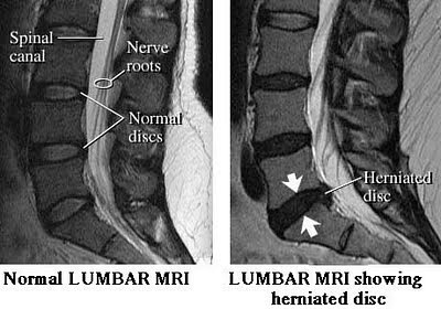 Lumbar Discs  Spine-health