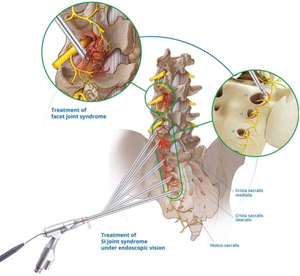 Endoscopic Sacral Neurotomy - Spinomax