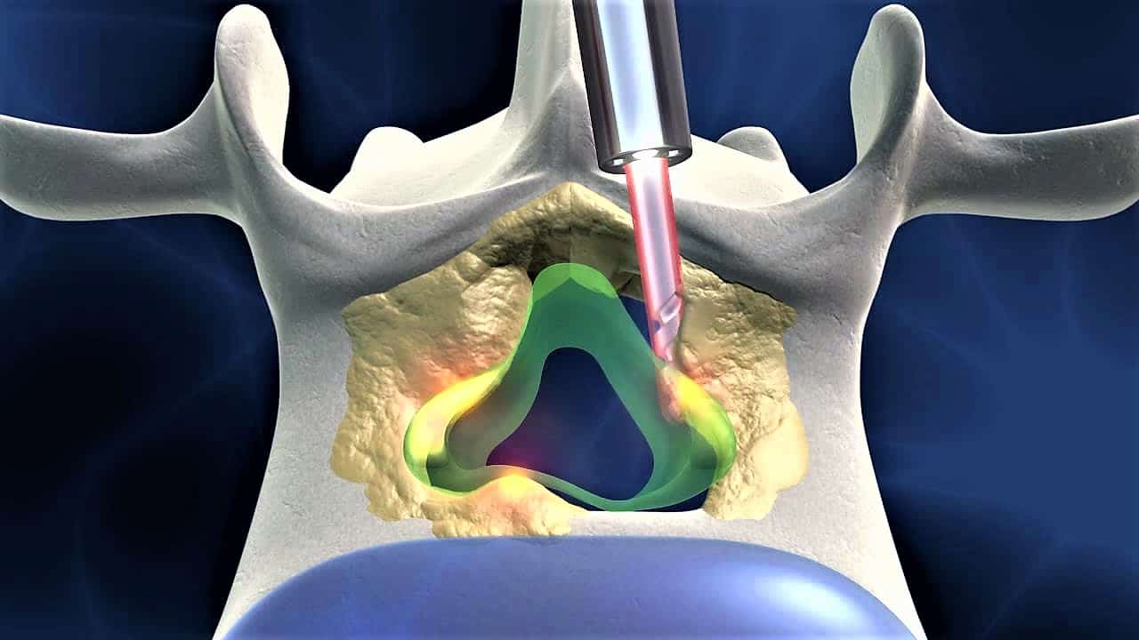 Ever-expanding role of endoscopy in spine diseases - Spinomax