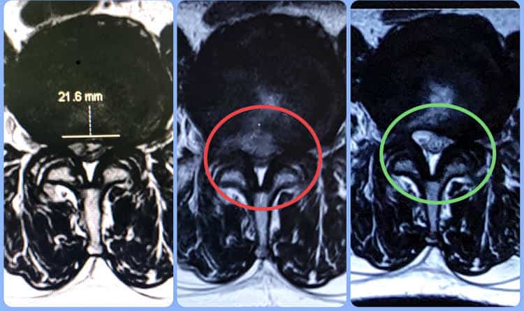 revision endoscopic decompression