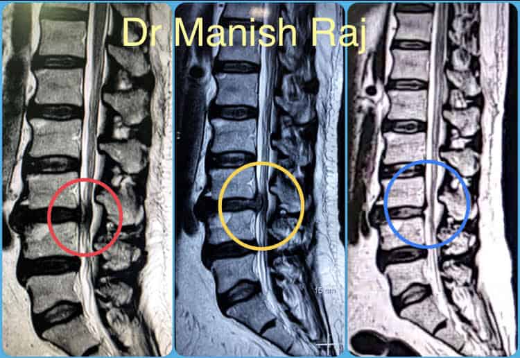 Treating back pain in Geriatric population (TCS-2) - Spinomax