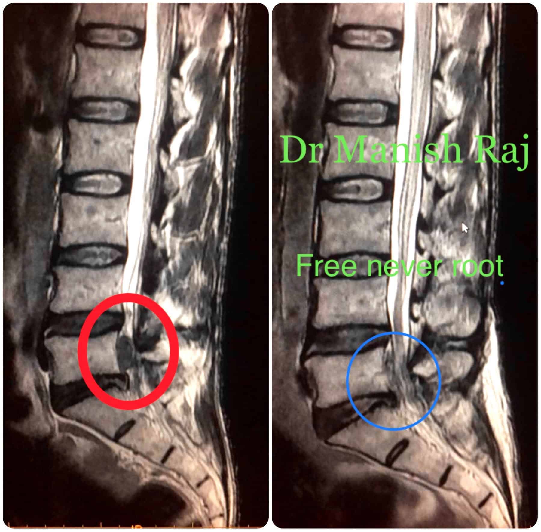 L3-L4 Treatment